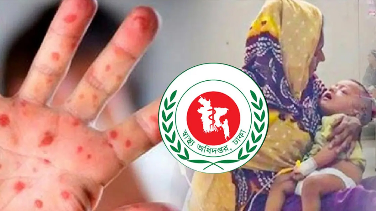 হামের উপসর্গ নিয়ে একদিনে ১১ শিশুর মৃত্যু