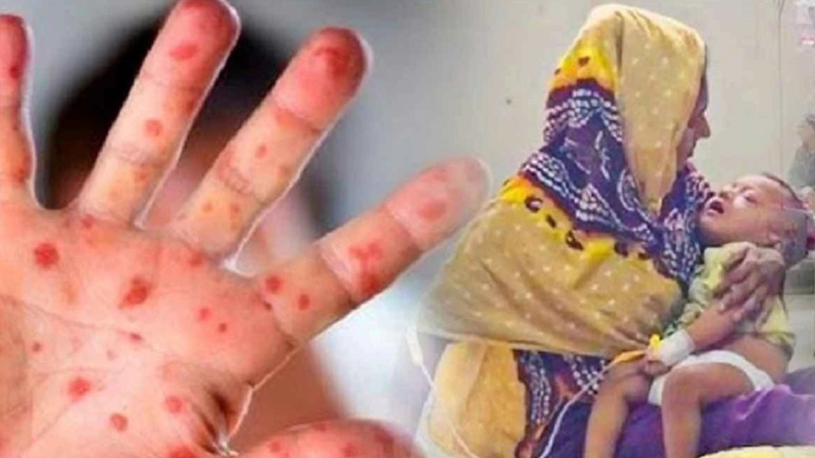 হাম ও উপসর্গে আরও ৭ শিশুর প্রাণহানি